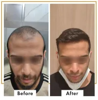 Perfection Hair Transplant Clinic