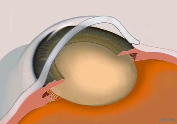 Cataract MD