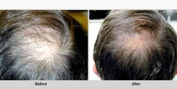 Hair Loss Treatment in Bangalore - Hairline International