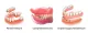 Complete Denture Care