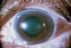 Cataract MD