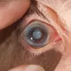 Cataract MD