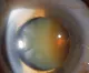 Cataract MD