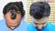 Perfection Hair Transplant Clinic