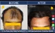 Perfection Hair Transplant Clinic