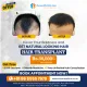 Perfection Hair Transplant Clinic