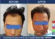 Perfection Hair Transplant Clinic