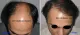 Perfection Hair Transplant Clinic