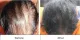 Hair Loss Treatment in Bangalore - Hairline International