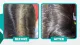 Hair Loss Treatment in Bangalore - Hairline International