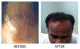 Hair Loss Treatment in Bangalore - Hairline International