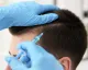 Hair Loss Treatment in Bangalore - Hairline International