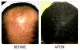 Hair Loss Treatment in Bangalore - Hairline International