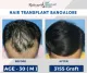 Hair Loss Treatment in Bangalore - Hairline International